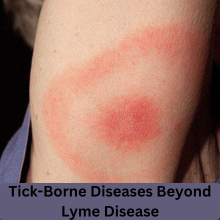 Lyme Disease